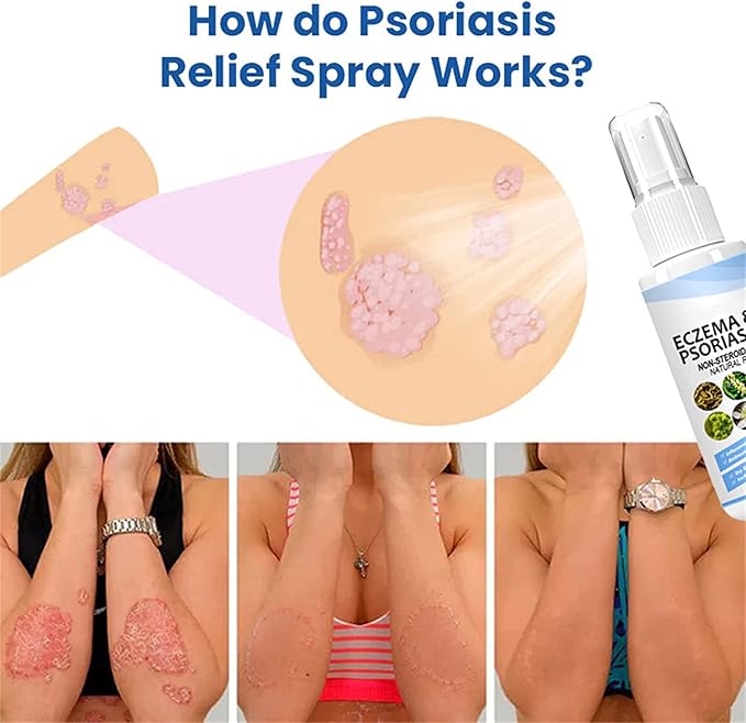 BUY1 GET1 FREE - Recommended by doctor Ecze+ Anti Fungal Spray