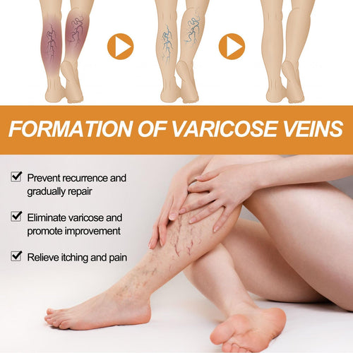 ( BUY 1 GET 2 ) Turmeric Varicose Vein Relief Spray